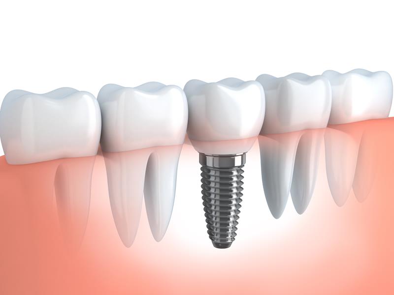 Dental Implants  Calimesa, CA 