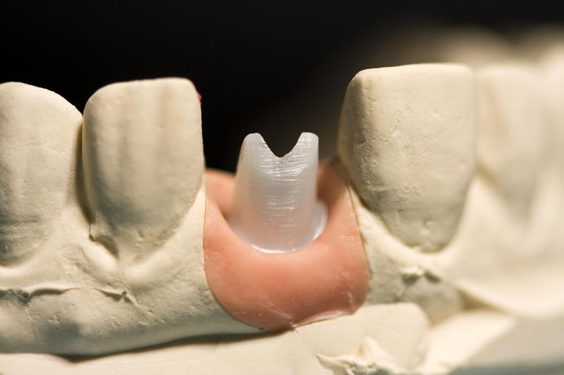 Implant Restoration  Calimesa, CA 