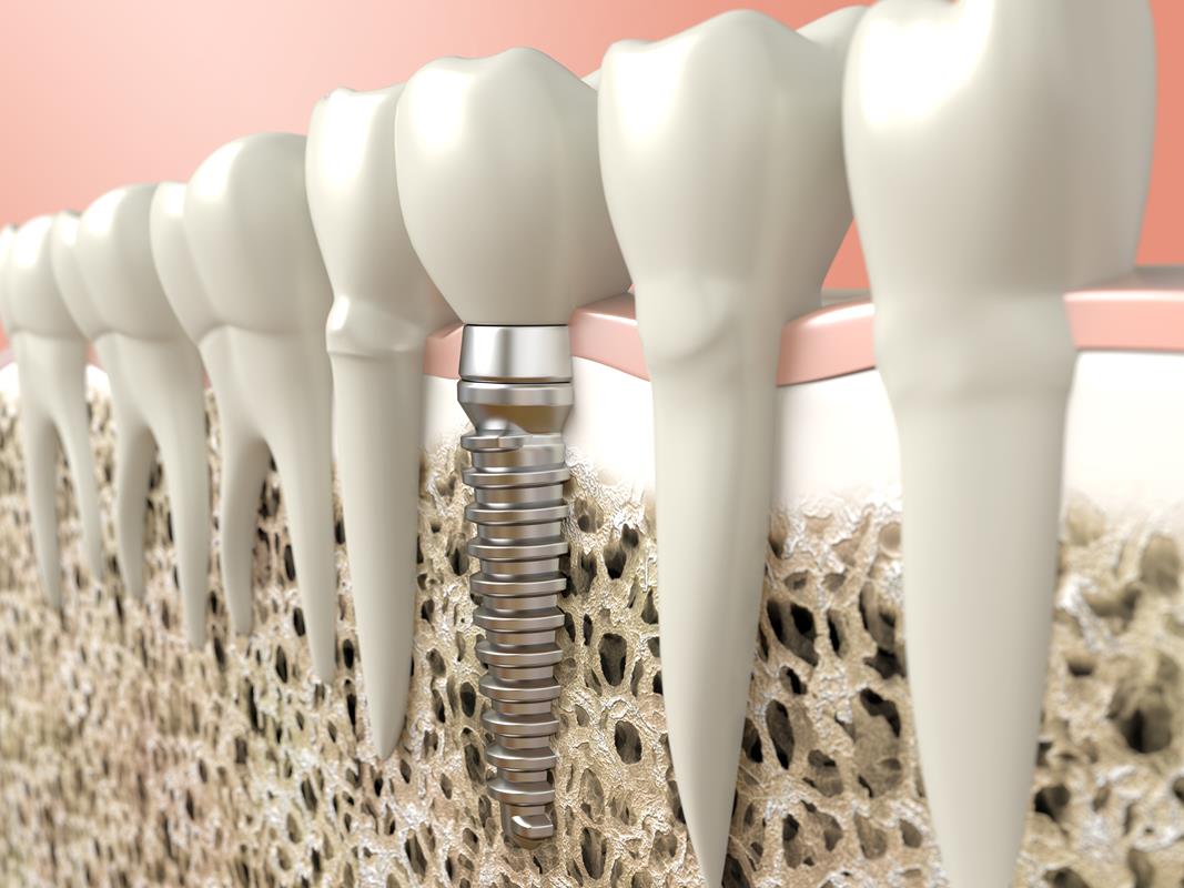 Dental Implants  Calimesa, CA 