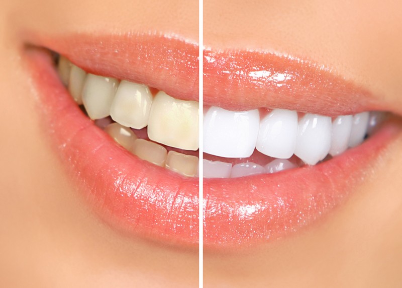 Teeth Whitening  Calimesa, CA 